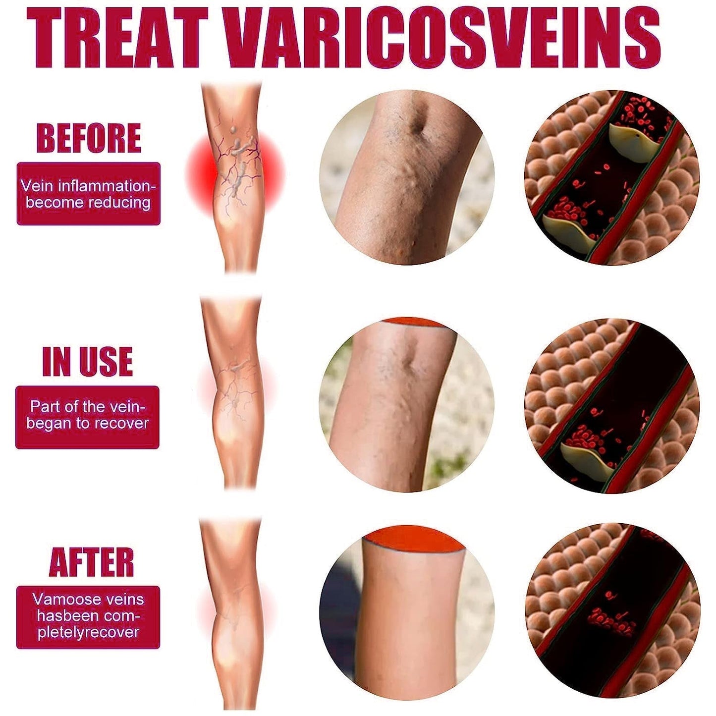 AQA™ Varicose Veins Treatment Patch